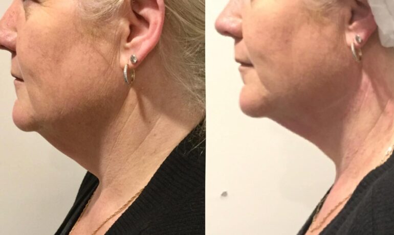 double chin treatment Sydney