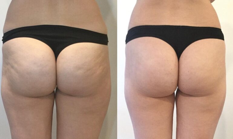 cellulite reduction treatment Wetherill Park