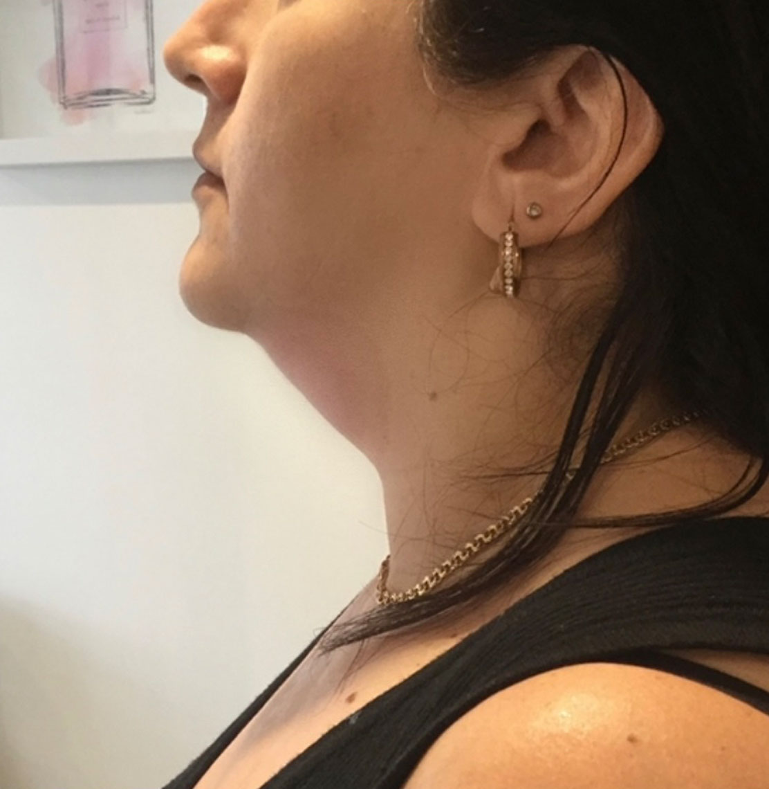 double chin treatment before and after