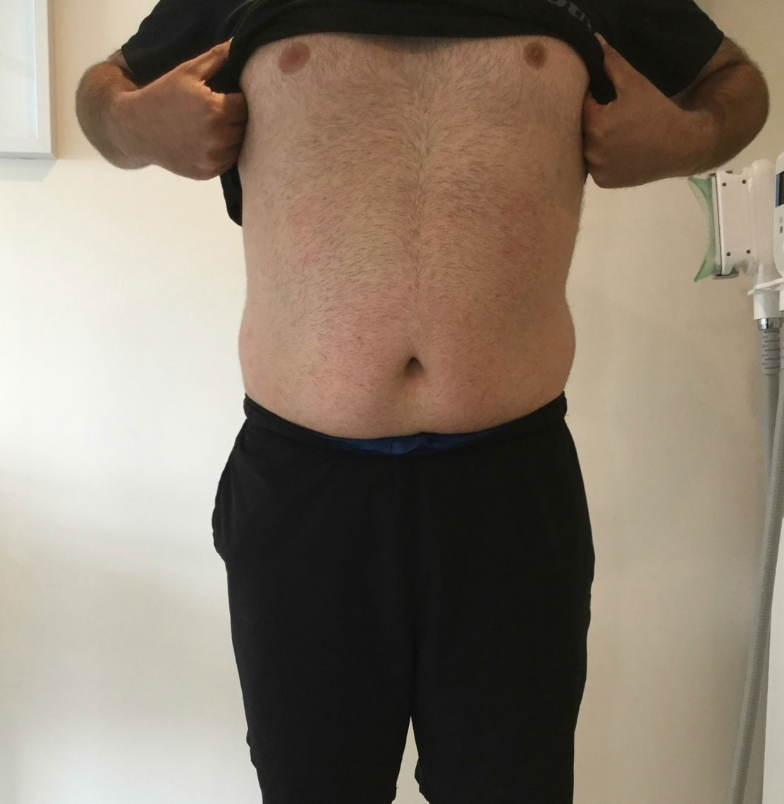 fat cavitation treatment before and after
