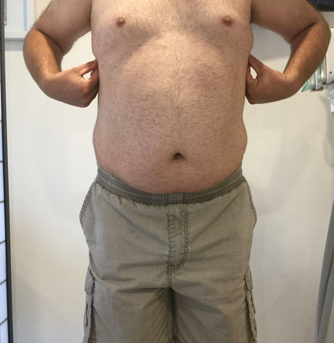 fat cavitation before and after photos