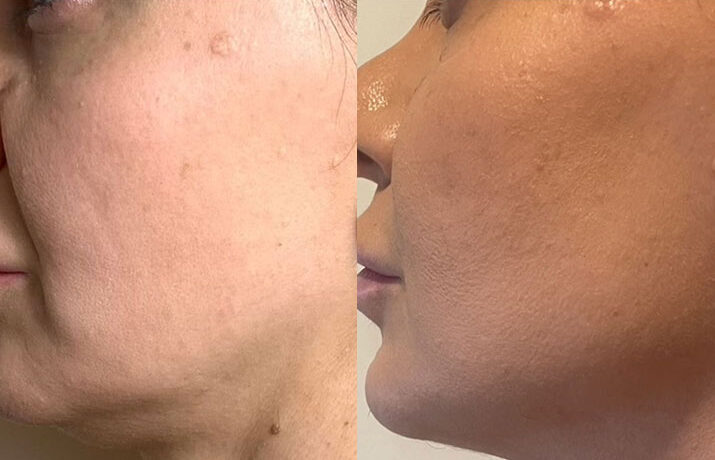 HIFU non-surgical facelift before and after