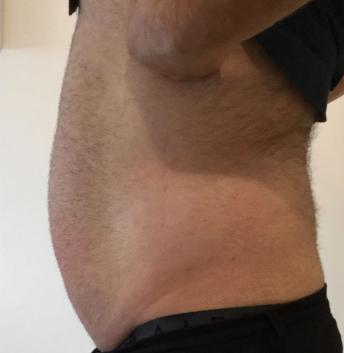 fat cavitation before and after men